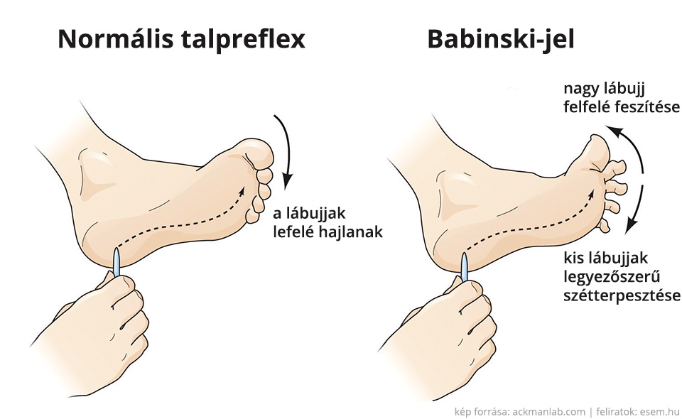 a nagy lábujj artrózisának kezelése)