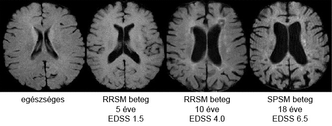 agysorvadás MRI felvétele