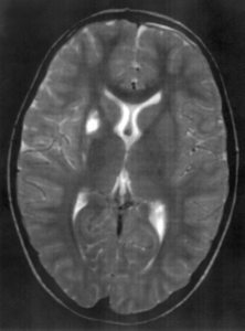 Lyme-kóros MRI felvétel