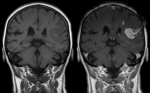Agyvérzés MRI képe kontrasztanyag nélkül és kontrasztanyaggal