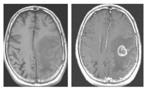 Agytumor MRI képe kontrasztanyag nélkül és kontrasztanyaggal