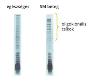 Monoklonális csík és oligoklonális csíkok az agy-gerincvelői folyadékban