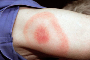 a Lyme-kór jellegzetes bőrtünete