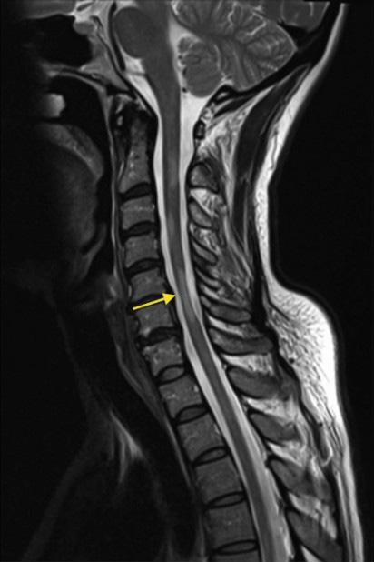 Spondylosis (nyaki, háti és ágyéki spondylosis) - Neurológia Magánrendelés Pécs – Akupunktúra Pécs