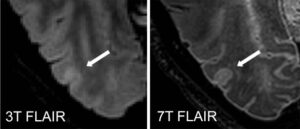 egymással megegyező, 3 és 7 Tesla erősségű MRI felvételek