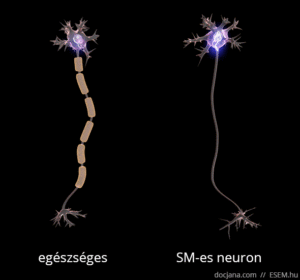 egészséges és SM-es neuron