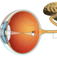 A látóideg állapotának jelentősége sclerosis multiplexben