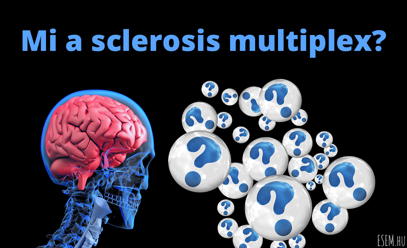 okoz e súlycsökkenést a sclerosis multiplex